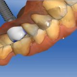 dental implant