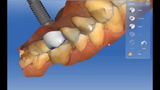 dental implant